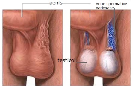 imagini afectiunile testiculare